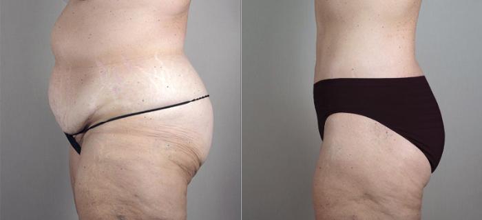 Body Lift Case 722 Before & After View #2 | Paramus, New Jersey | Parker Center for Plastic Surgery