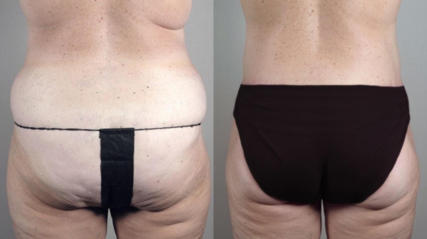 Body Lift Case 722 Before & After View #3 | Paramus, New Jersey | Parker Center for Plastic Surgery