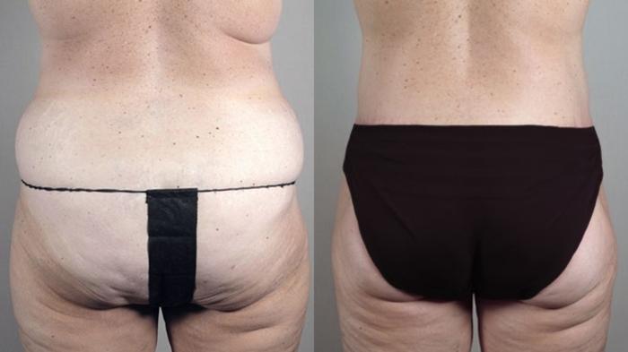 Body Lift Case 722 Before & After View #3 | Paramus, New Jersey | Parker Center for Plastic Surgery