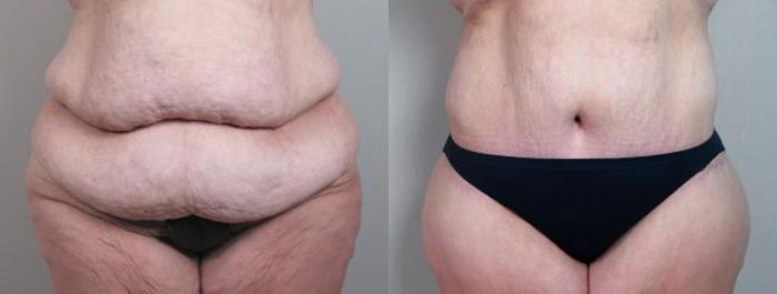 Body Lift Case 751 Before & After View #1 | Paramus, New Jersey | Parker Center for Plastic Surgery