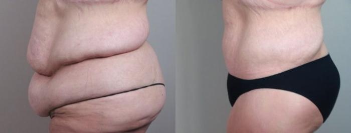 Body Lift Case 751 Before & After View #2 | Paramus, New Jersey | Parker Center for Plastic Surgery