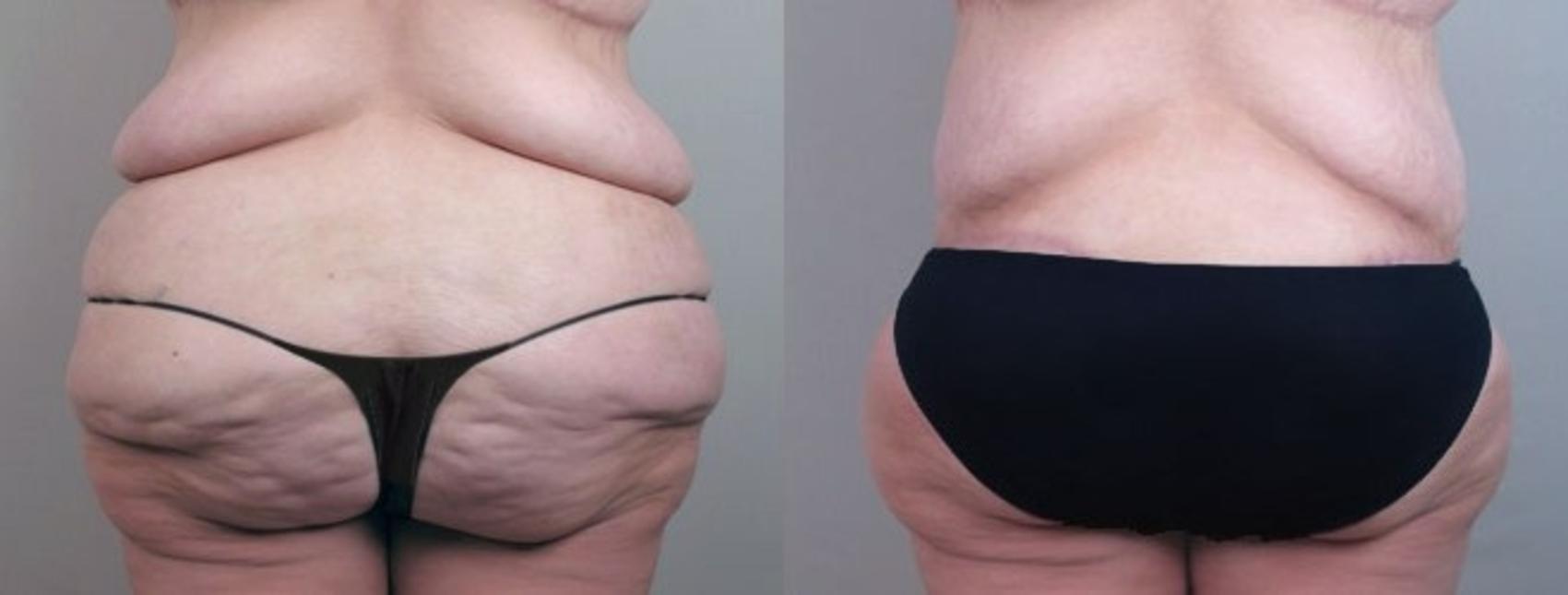 Body Lift Case 751 Before & After View #3 | Paramus, New Jersey | Parker Center for Plastic Surgery