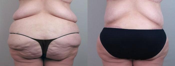 Body Lift Case 751 Before & After View #3 | Paramus, New Jersey | Parker Center for Plastic Surgery