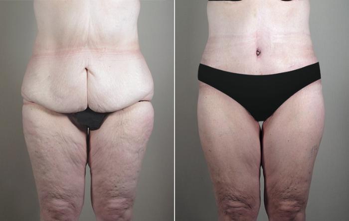Body Lift Case 753 Before & After View #1 | Paramus, New Jersey | Parker Center for Plastic Surgery