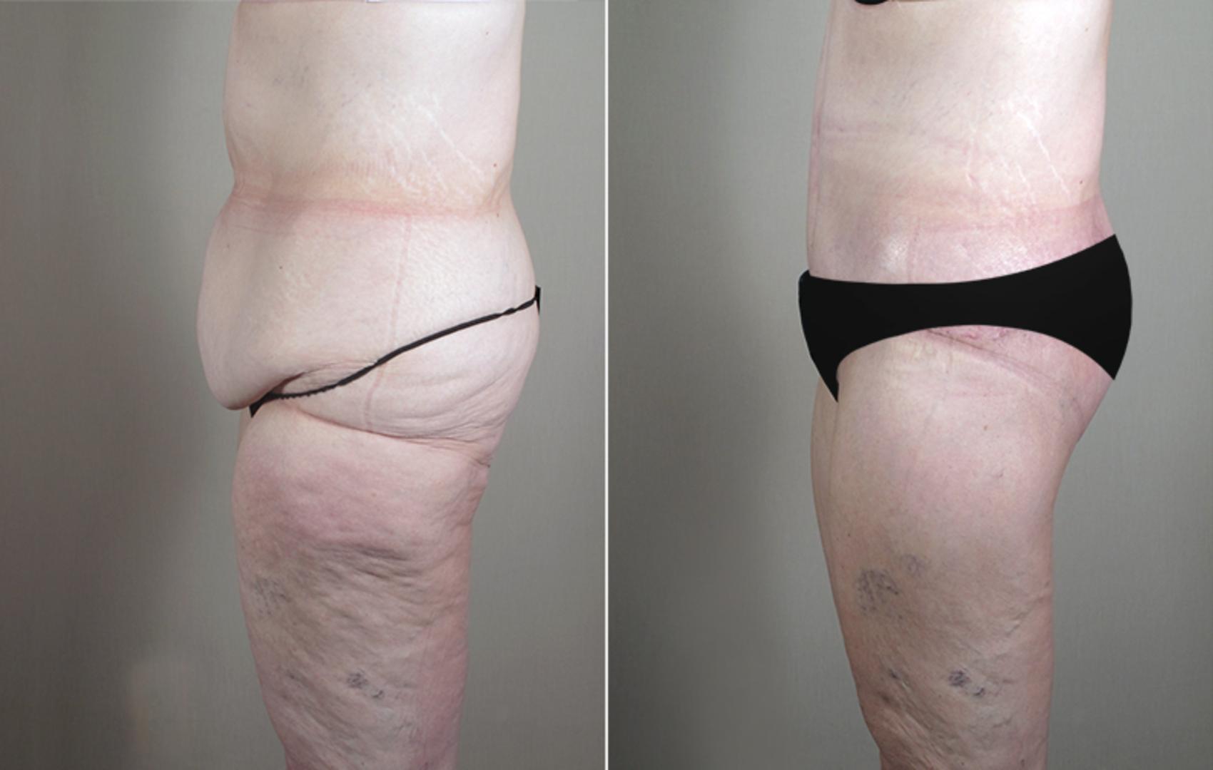 Body Lift Case 753 Before & After View #2 | Paramus, New Jersey | Parker Center for Plastic Surgery