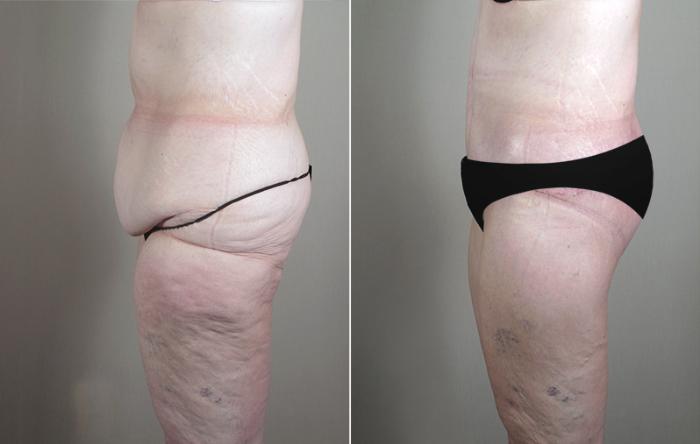 Body Lift Case 753 Before & After View #2 | Paramus, New Jersey | Parker Center for Plastic Surgery