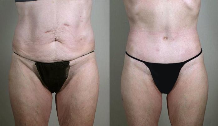 Body Lift Case 754 Before & After View #1 | Paramus, New Jersey | Parker Center for Plastic Surgery