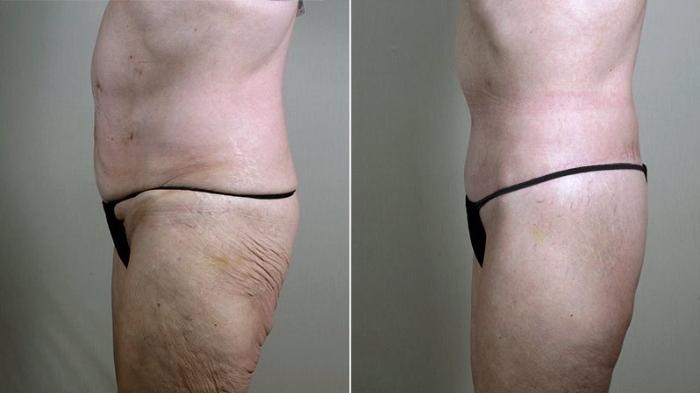 Body Lift Case 754 Before & After View #2 | Paramus, New Jersey | Parker Center for Plastic Surgery