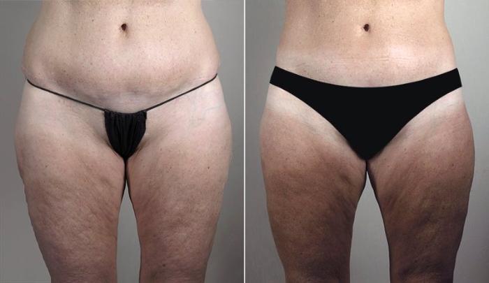 Body Lift Case 755 Before & After View #1 | Paramus, New Jersey | Parker Center for Plastic Surgery