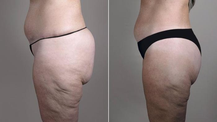 Body Lift Case 755 Before & After View #2 | Paramus, New Jersey | Parker Center for Plastic Surgery