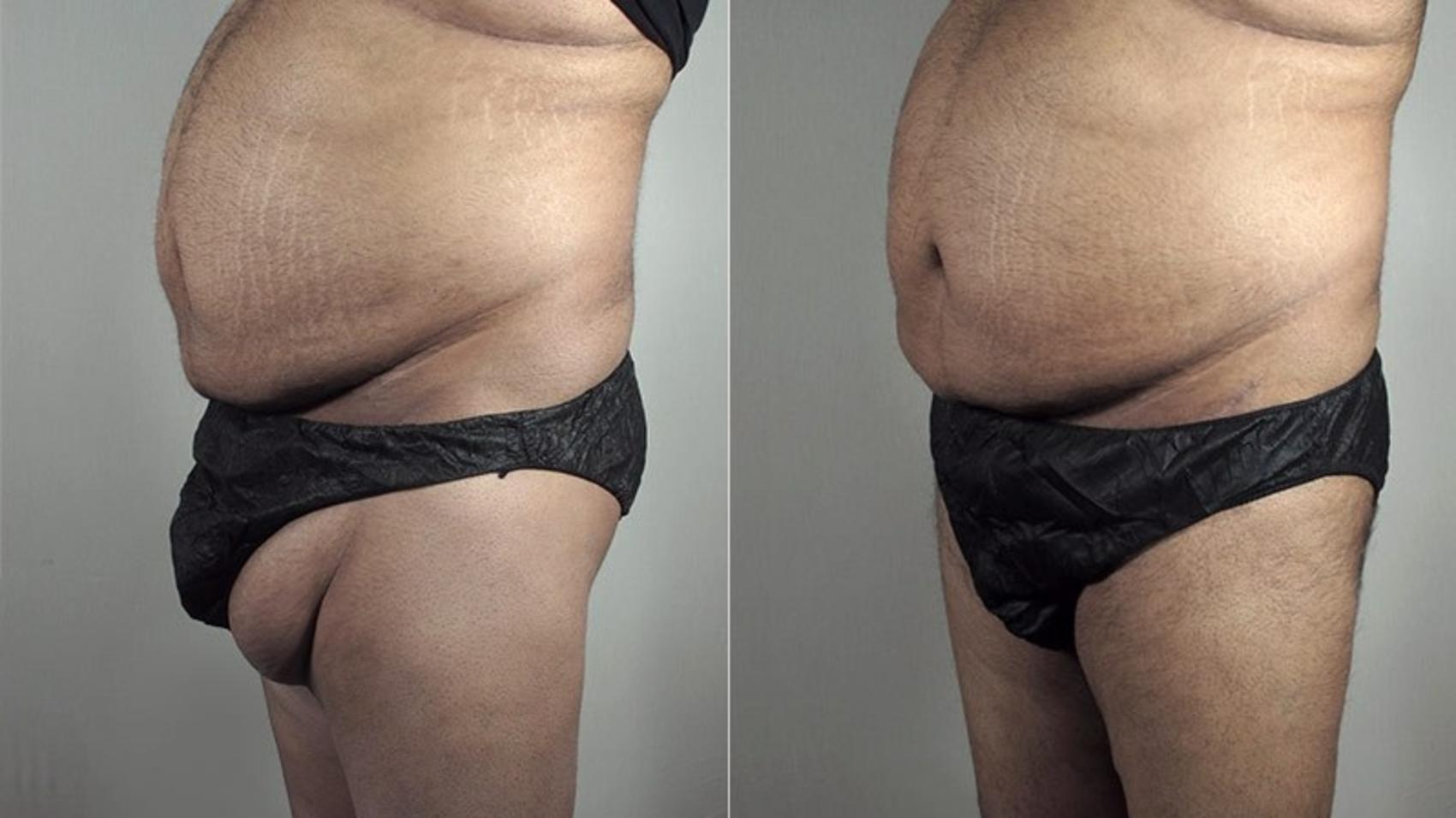 Body Lift Case 819 Before & After View #1 | Paramus, New Jersey | Parker Center for Plastic Surgery