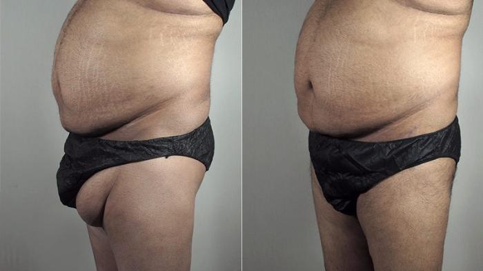 Body Lift Case 819 Before & After View #1 | Paramus, New Jersey | Parker Center for Plastic Surgery