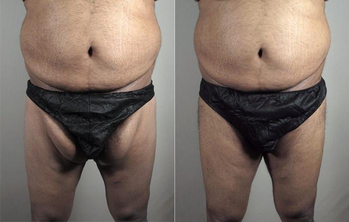 Body Lift Case 819 Before & After View #2 | Paramus, New Jersey | Parker Center for Plastic Surgery