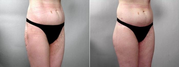 Body Lift Case 920 Before & After View #2 | Paramus, New Jersey | Parker Center for Plastic Surgery