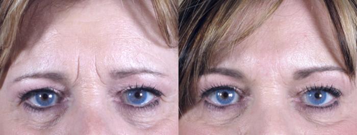 BOTOX® & Jeuveau® Case 271 Before & After View #1 | Paramus, New Jersey | Parker Center for Plastic Surgery