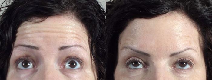 BOTOX® & Jeuveau® Case 299 Before & After View #1 | Paramus, New Jersey | Parker Center for Plastic Surgery