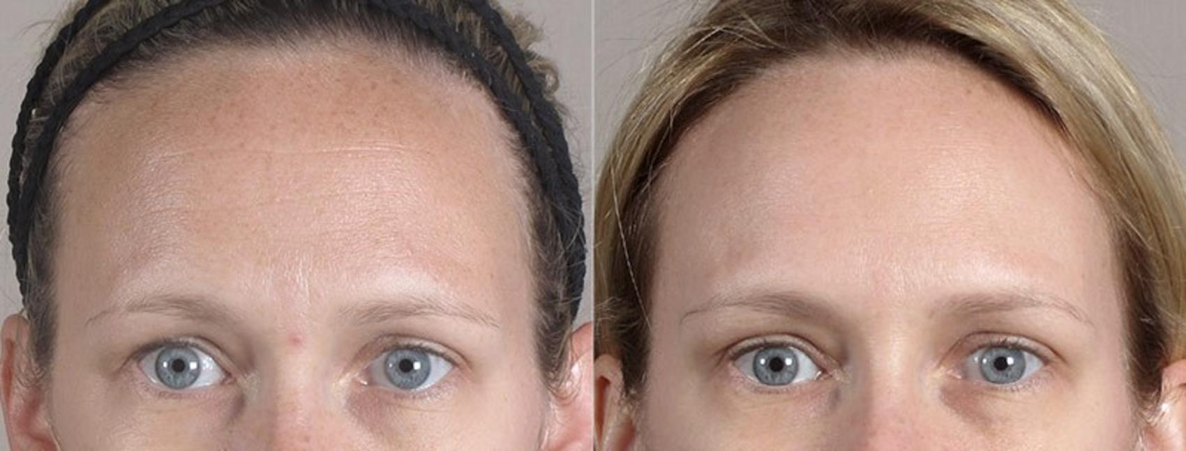 BOTOX® & Jeuveau® Case 300 Before & After View #1 | Paramus, New Jersey | Parker Center for Plastic Surgery