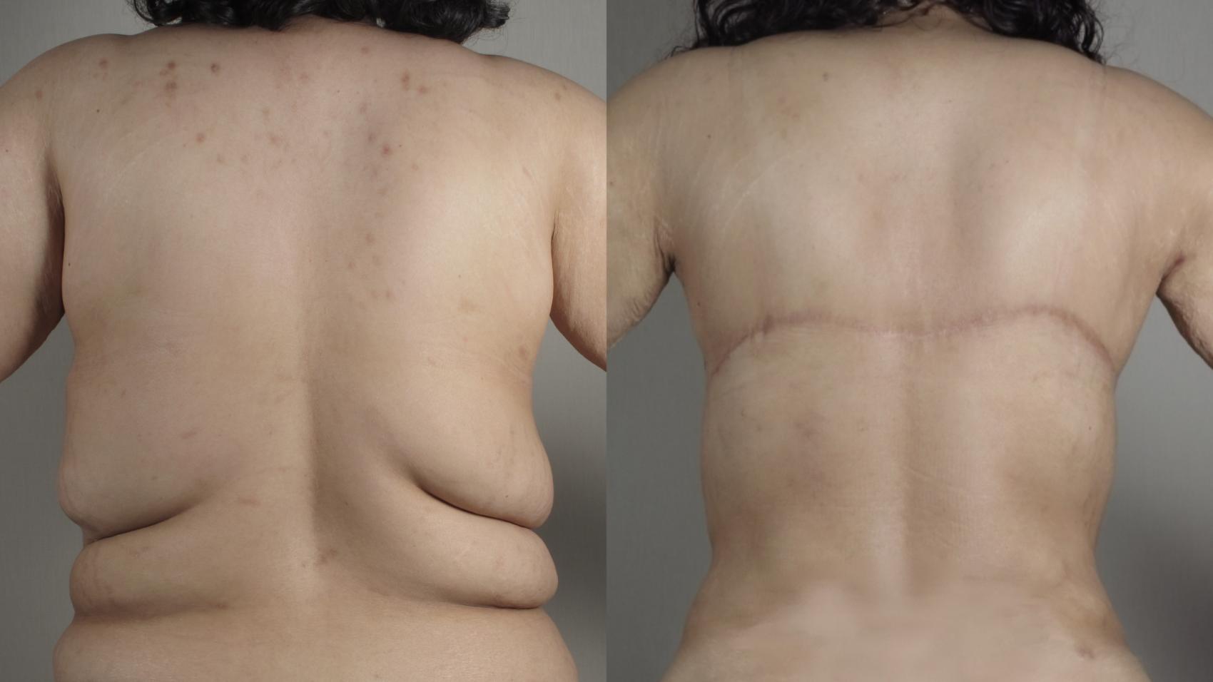 Bra Line Back Lift Case 1024 Before & After Back | Paramus, New Jersey | Parker Center for Plastic Surgery
