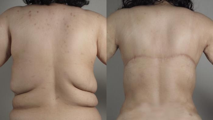 Bra Line Back Lift Case 1024 Before & After Back | Paramus, New Jersey | Parker Center for Plastic Surgery