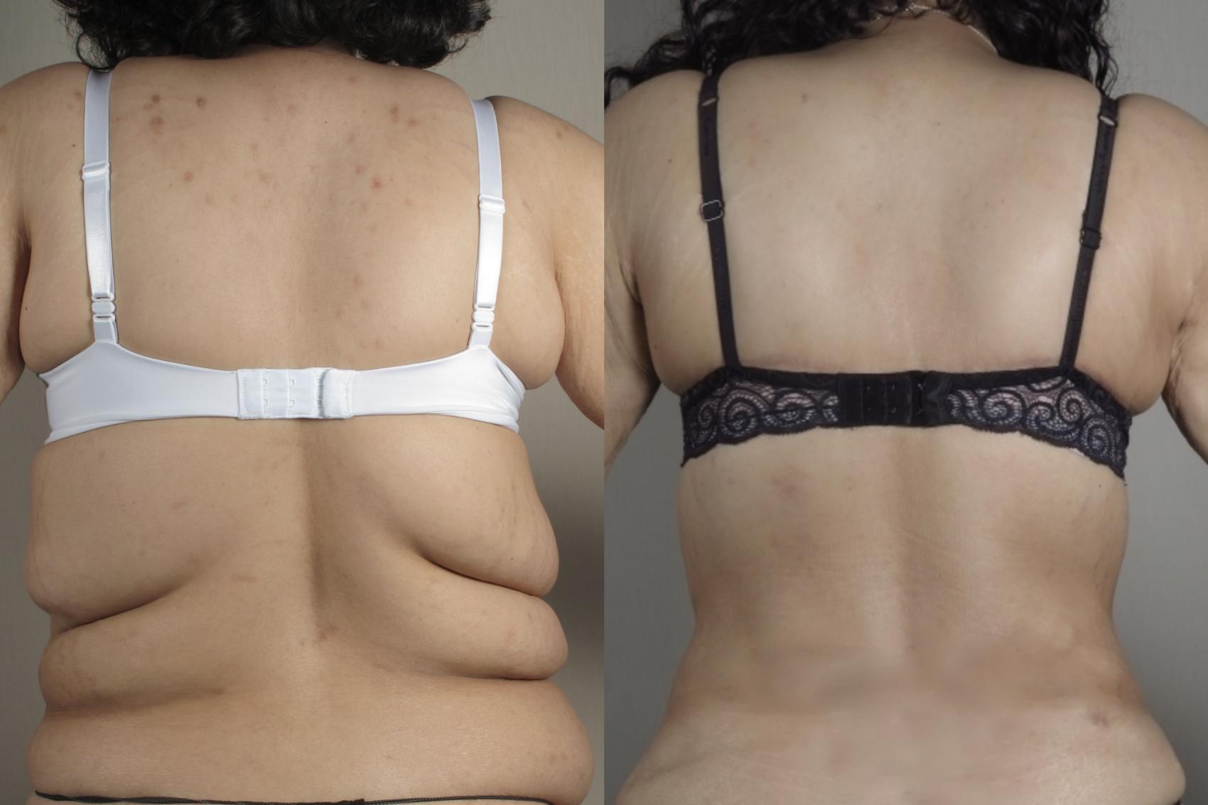 Bra Line Back Lift Case 1024 Before & After Back w bra | Paramus, New Jersey | Parker Center for Plastic Surgery