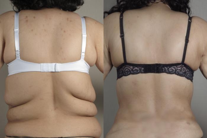 Bra Line Back Lift Case 1024 Before & After Back w bra | Paramus, New Jersey | Parker Center for Plastic Surgery