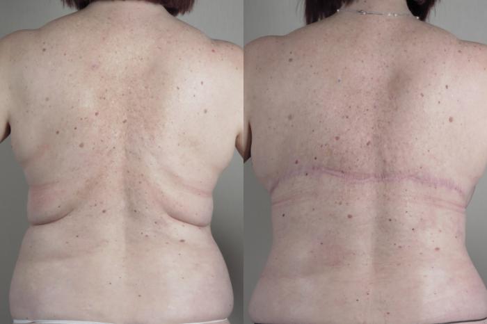 Bra Line Back Lift Case 1314 Before & After back  | Paramus, New Jersey | Parker Center for Plastic Surgery