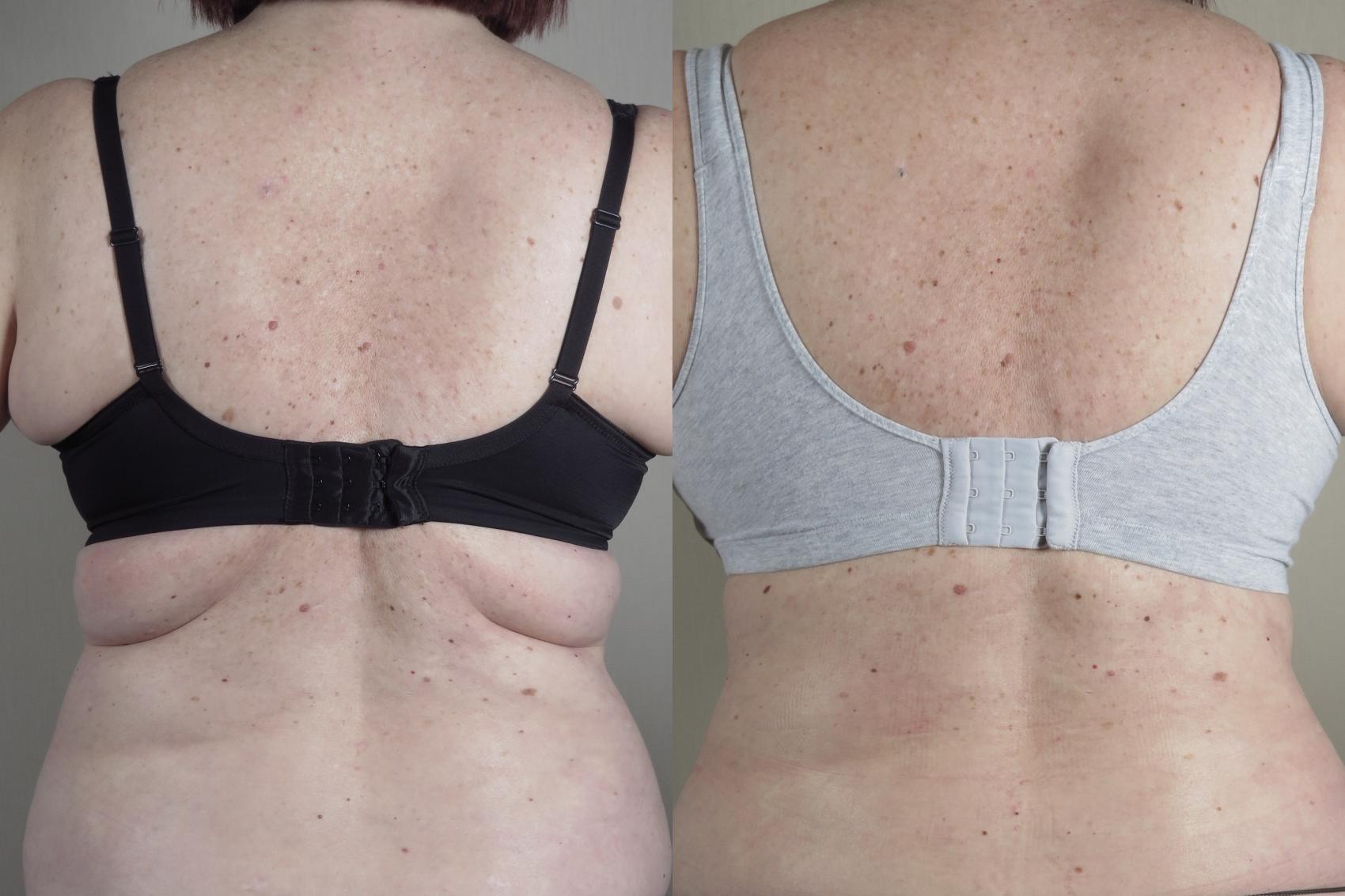 Bra Line Back Lift Case 1314 Before & After Back | Paramus, New Jersey | Parker Center for Plastic Surgery