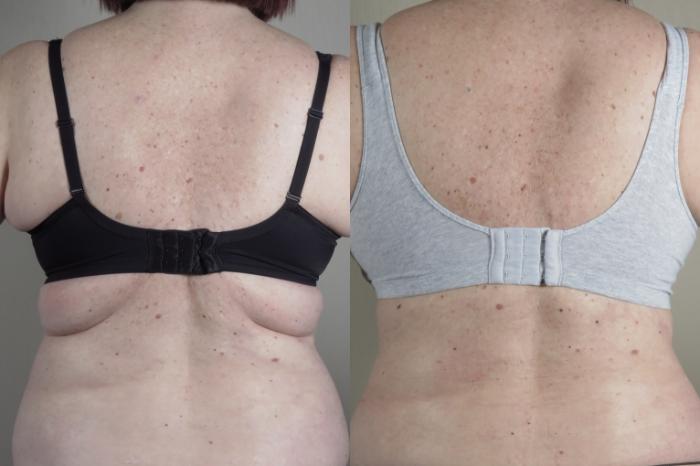 Bra Line Back Lift Case 1314 Before & After Back | Paramus, New Jersey | Parker Center for Plastic Surgery