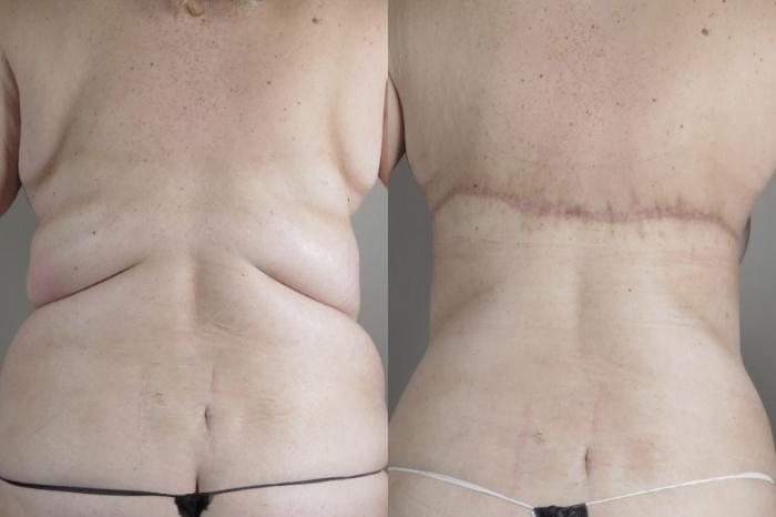 Bra Line Back Lift Case 1315 Before & After Back | Paramus, New Jersey | Parker Center for Plastic Surgery
