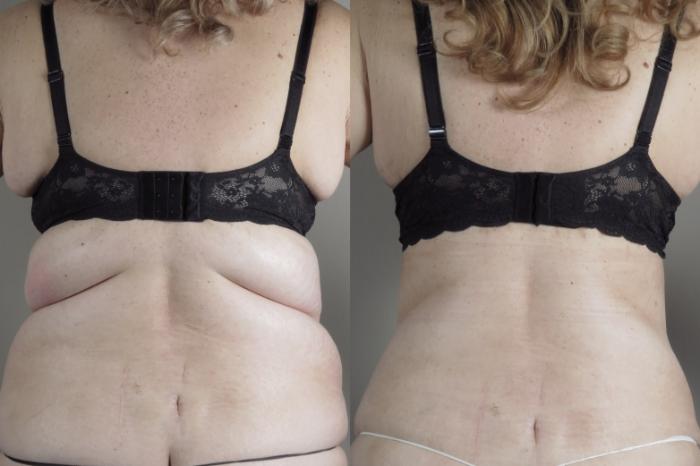 Bra Line Back Lift Case 1315 Before & After back view 2 bra | Paramus, New Jersey | Parker Center for Plastic Surgery
