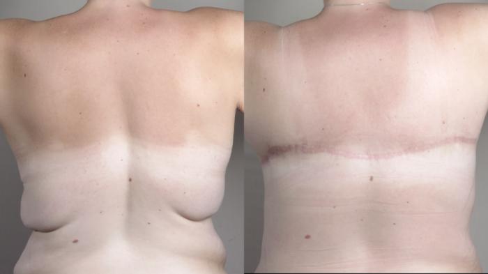 Bra Line Back Lift Case 1318 Before & After back  | Paramus, New Jersey | Parker Center for Plastic Surgery