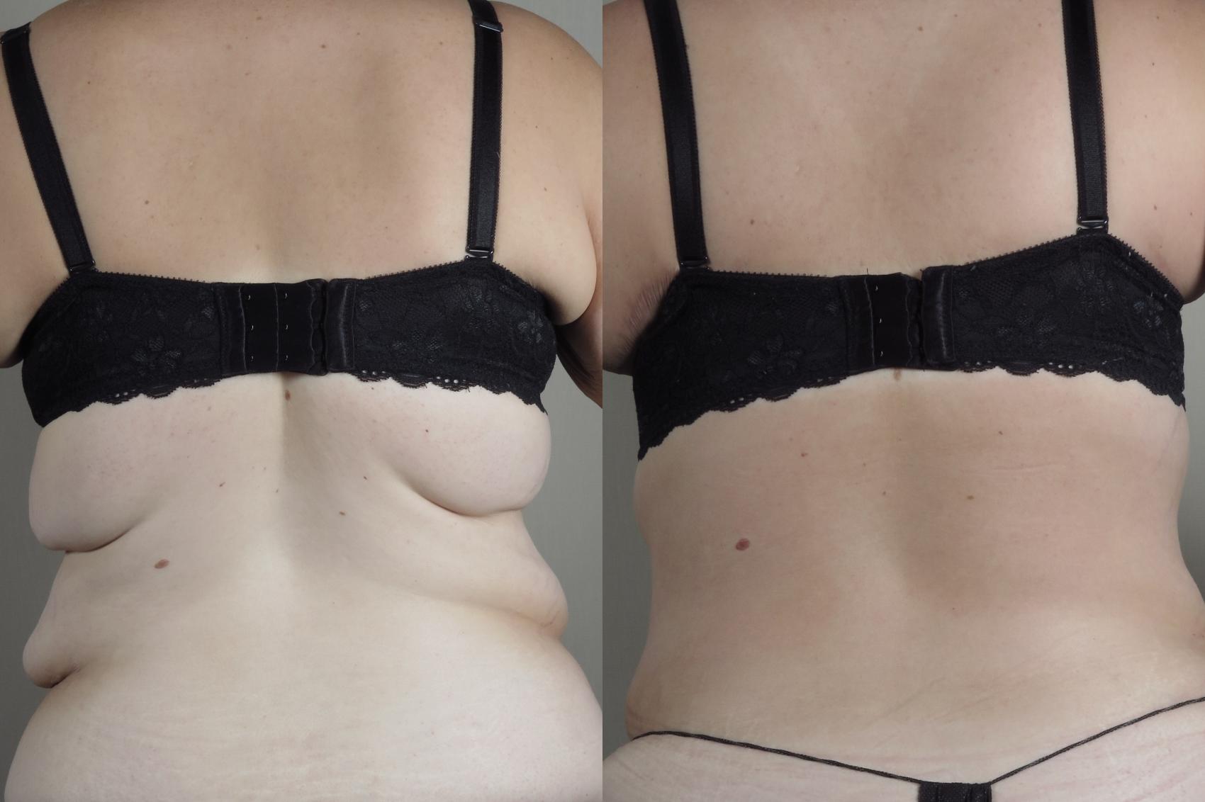 Bra Line Back Lift Case 1318 Before & After Back | Paramus, New Jersey | Parker Center for Plastic Surgery