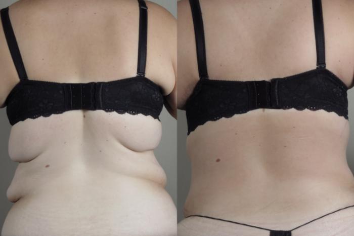 Bra Line Back Lift Case 1318 Before & After Back | Paramus, New Jersey | Parker Center for Plastic Surgery