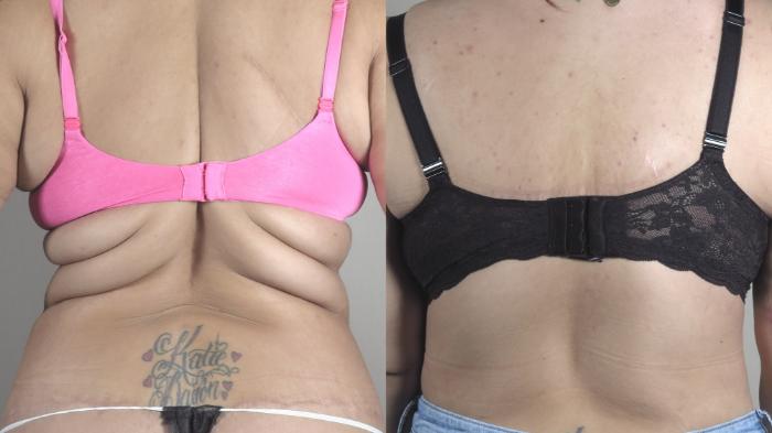 Bra Line Back Lift Case 1335 Before & After Back | Paramus, New Jersey | Parker Center for Plastic Surgery