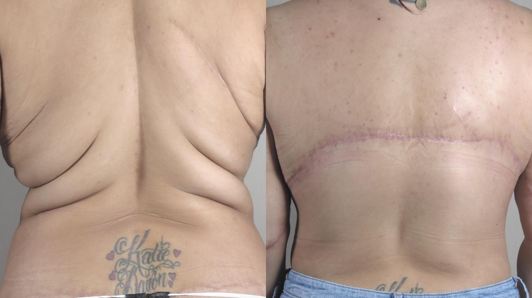 Bra Line Back Lift Case 1335 Before & After back view 2 braless  | Paramus, New Jersey | Parker Center for Plastic Surgery