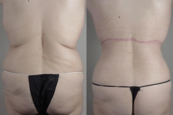 Bra Line Back Lift Case 1375 Before & After Back | Paramus, New Jersey | Parker Center for Plastic Surgery