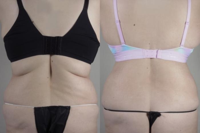 Bra Line Back Lift Case 1375 Before & After back with bra  | Paramus, New Jersey | Parker Center for Plastic Surgery