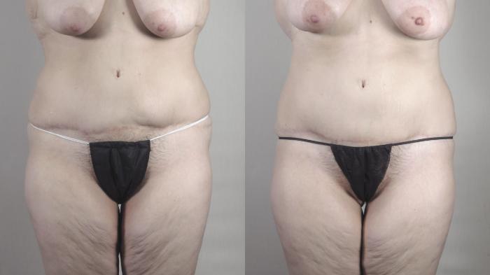 Bra Line Back Lift Case 1375 Before & After Front | Paramus, New Jersey | Parker Center for Plastic Surgery