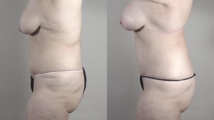 Bra Line Back Lift Case 1375 Before & After Left Side | Paramus, New Jersey | Parker Center for Plastic Surgery