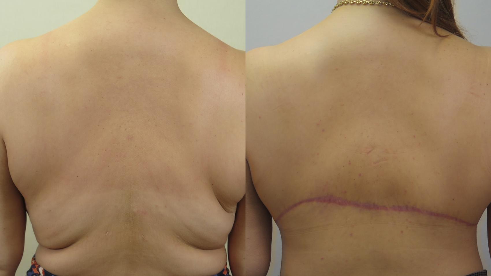 Bra Line Back Lift Case 1555 Before & After Back | Paramus, New Jersey | Parker Center for Plastic Surgery