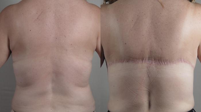 Bra Line Back Lift Case 1648 Before & After Back | Paramus, New Jersey | Parker Center for Plastic Surgery