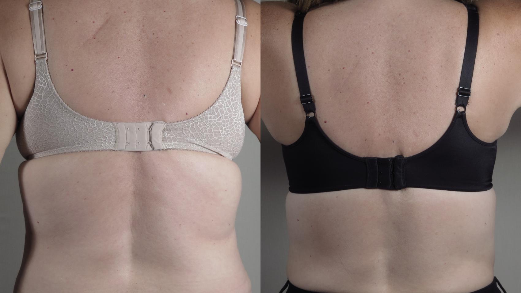 Bra Line Back Lift Case 1648 Before & After Front | Paramus, New Jersey | Parker Center for Plastic Surgery