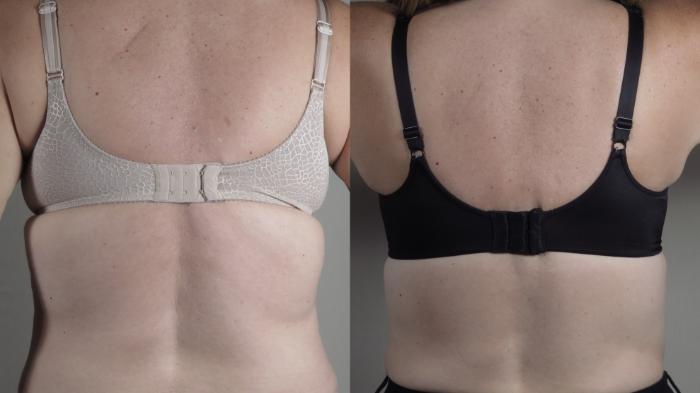 Bra Line Back Lift Case 1648 Before & After Front | Paramus, New Jersey | Parker Center for Plastic Surgery