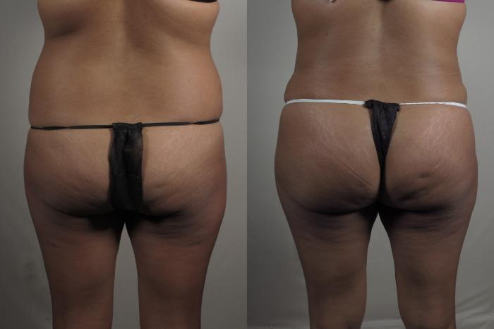 Brazilian Butt Lift Case 1014 Before & After Back | Paramus, New Jersey | Parker Center for Plastic Surgery