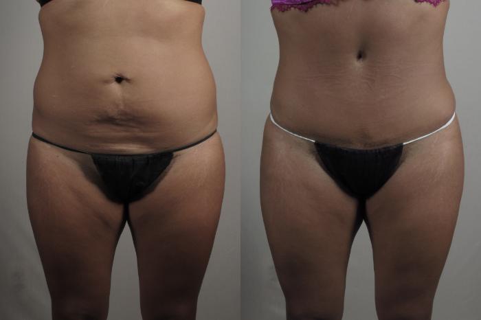 Brazilian Butt Lift Case 1014 Before & After Front | Paramus, New Jersey | Parker Center for Plastic Surgery