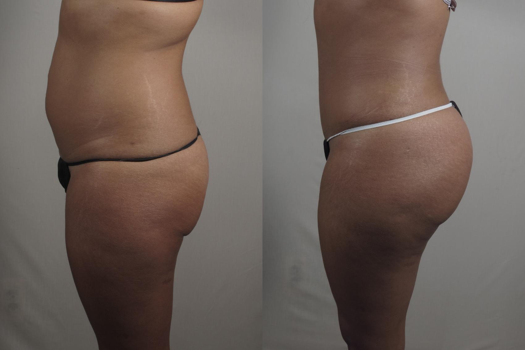 Brazilian Butt Lift Case 1014 Before & After Right Side | Paramus, New Jersey | Parker Center for Plastic Surgery