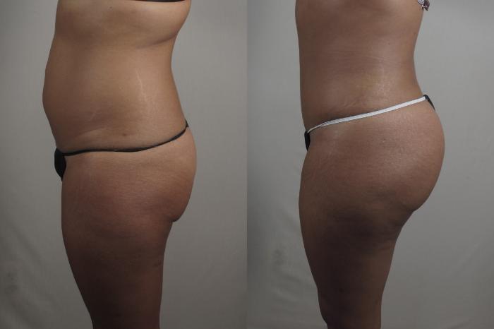 Brazilian Butt Lift Case 1014 Before & After Right Side | Paramus, New Jersey | Parker Center for Plastic Surgery