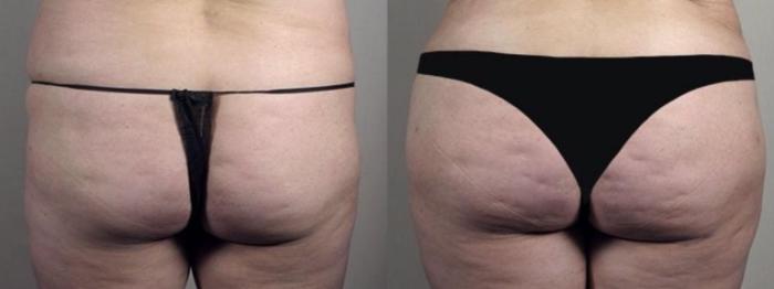 Brazilian Butt Lift Case 1339 Before & After Back | Paramus, New Jersey | Parker Center for Plastic Surgery