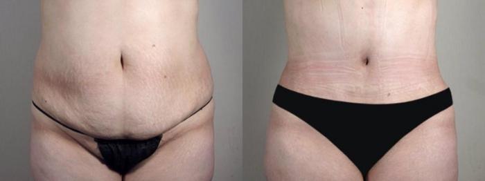 Brazilian Butt Lift Case 1339 Before & After Front | Paramus, New Jersey | Parker Center for Plastic Surgery