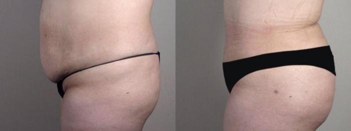 Brazilian Butt Lift Case 1339 Before & After Left Side | Paramus, New Jersey | Parker Center for Plastic Surgery
